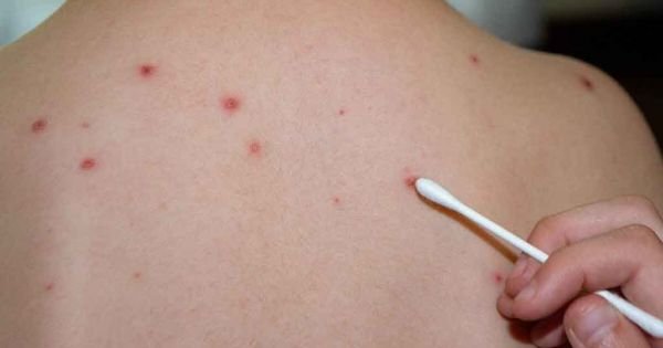 Ogłoszą awaryjne w Paragwaju w celu wybuchu odry - Mercopress